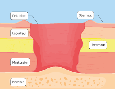 Diagnose Dekubitus KUBIVENT diagnose-dekubitus-kubivent